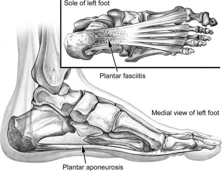 A picture of Plantar aponeurosis