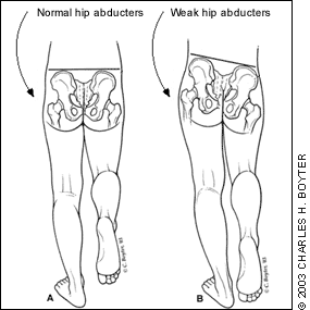 Weak hip abductor muscles